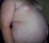 606px-Central_Obesity_011