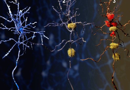 Alzheimers 17 Image