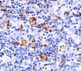 Hodgkin_lymphoma_(4)_CD30_immunostain