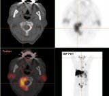 Prostate Cancer Image